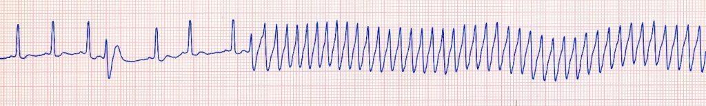 ECG from a dog with collapse due to ventricular tachycardia.