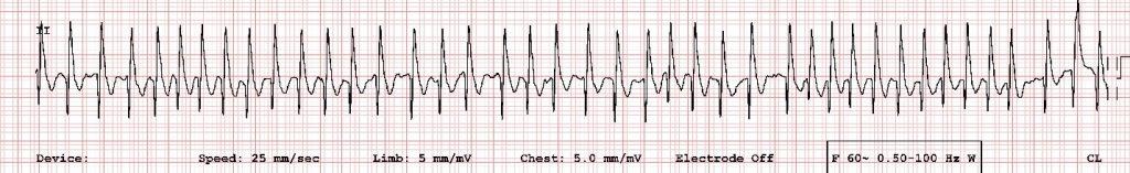 ECG from a dog with atrial fibrillation.