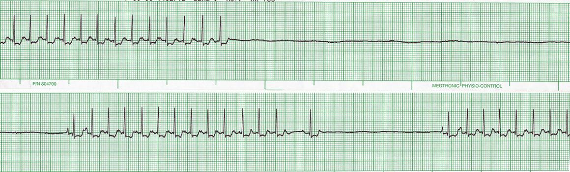 ECG tracing from a dog with fainting due to a slow heart rate (bradycardia).