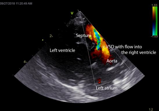 A labeled still picture of a cat with ventricular septal defect with color showing where blood flows abnormally through the hole in the heart.