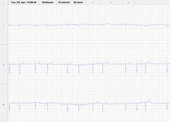 a resting echocardiogram of atrial fibrillation