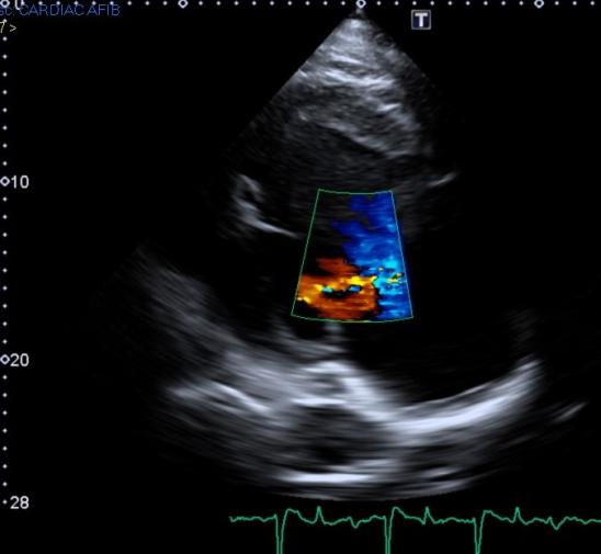 echocardiogram of mitral regurgitation
