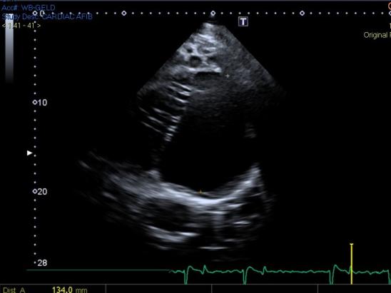 echocardiogram of left atrial size