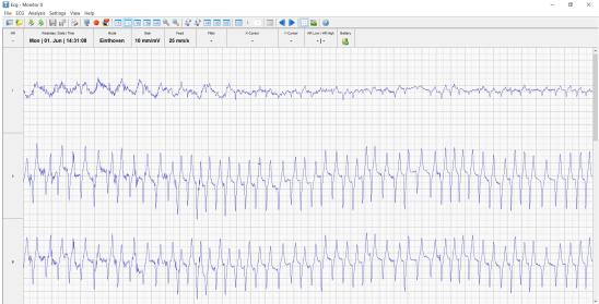 exercising echocardiogram of afib