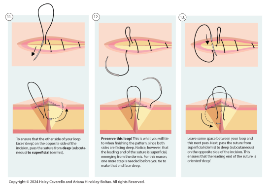 illustration of how to create a buried closing while suturing.
