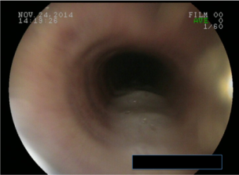 Moderate amount of mucus in airway