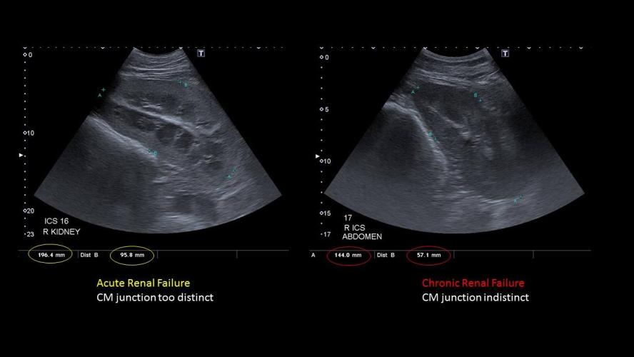 Ultrasound renal failure