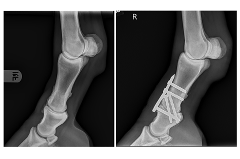 Two black and white Radiograph showing arthrodesis before surgery (Left) and after surgery (Right)